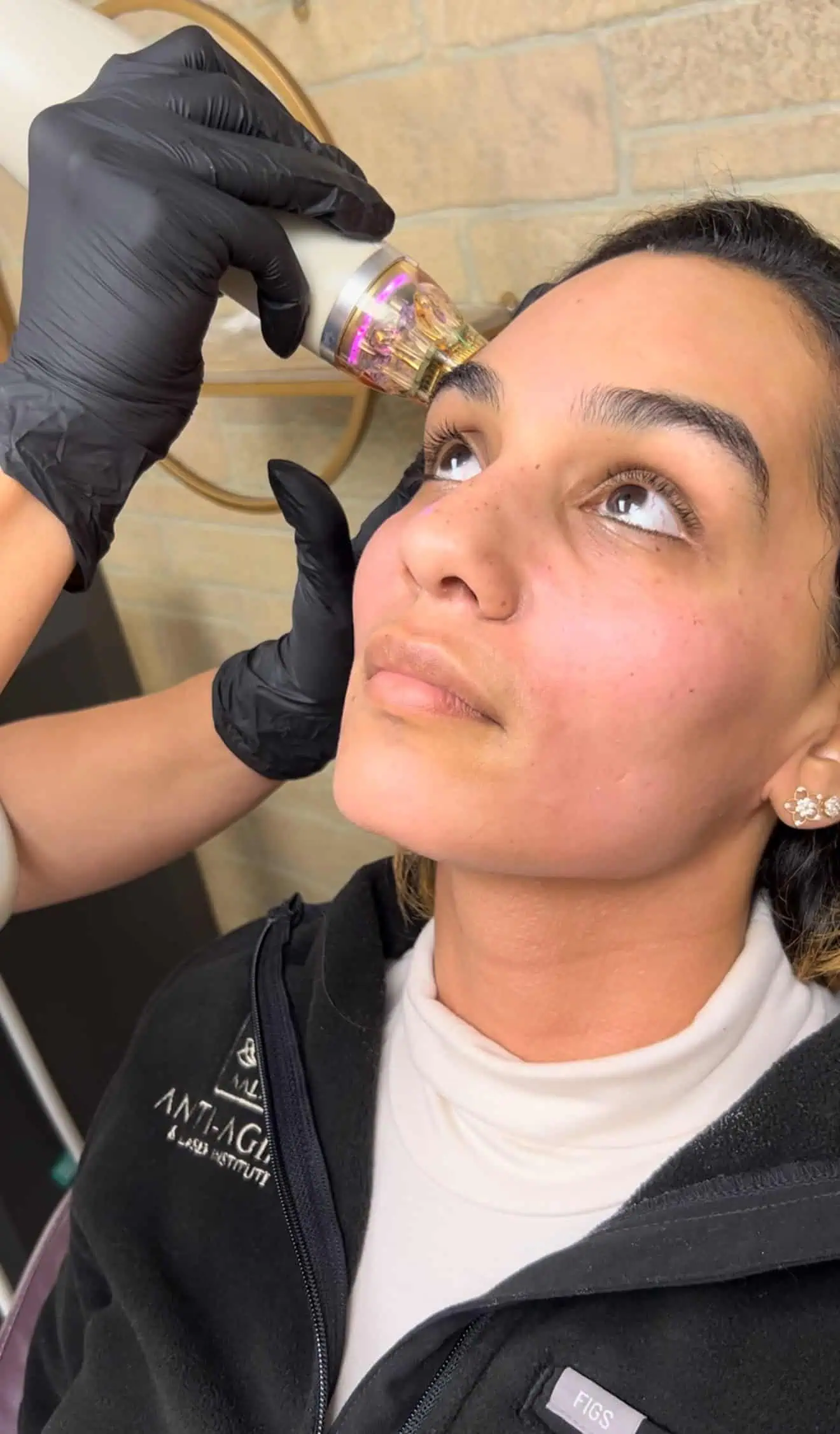 Woman receiving PRP microneedling treatment on her face.