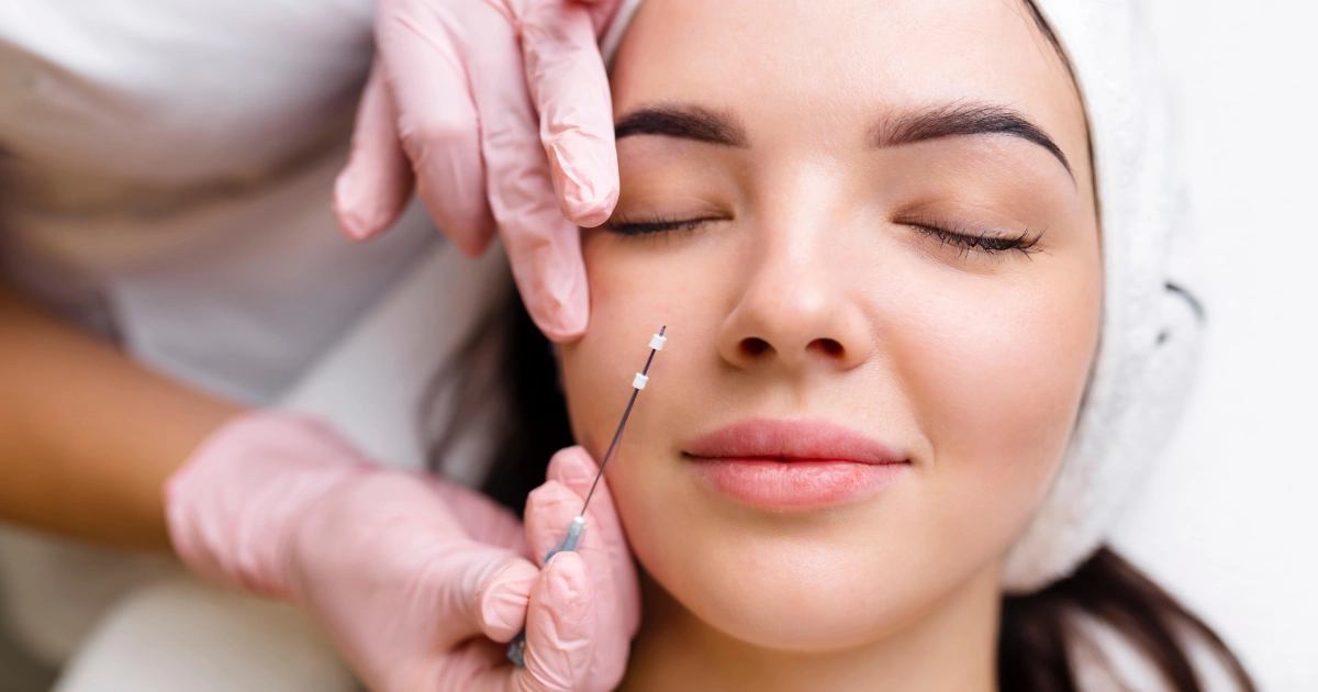 A woman receiving a PDO Thread Lift in Providence, RI as a gloved professional inserts a PDO thread into her cheek.