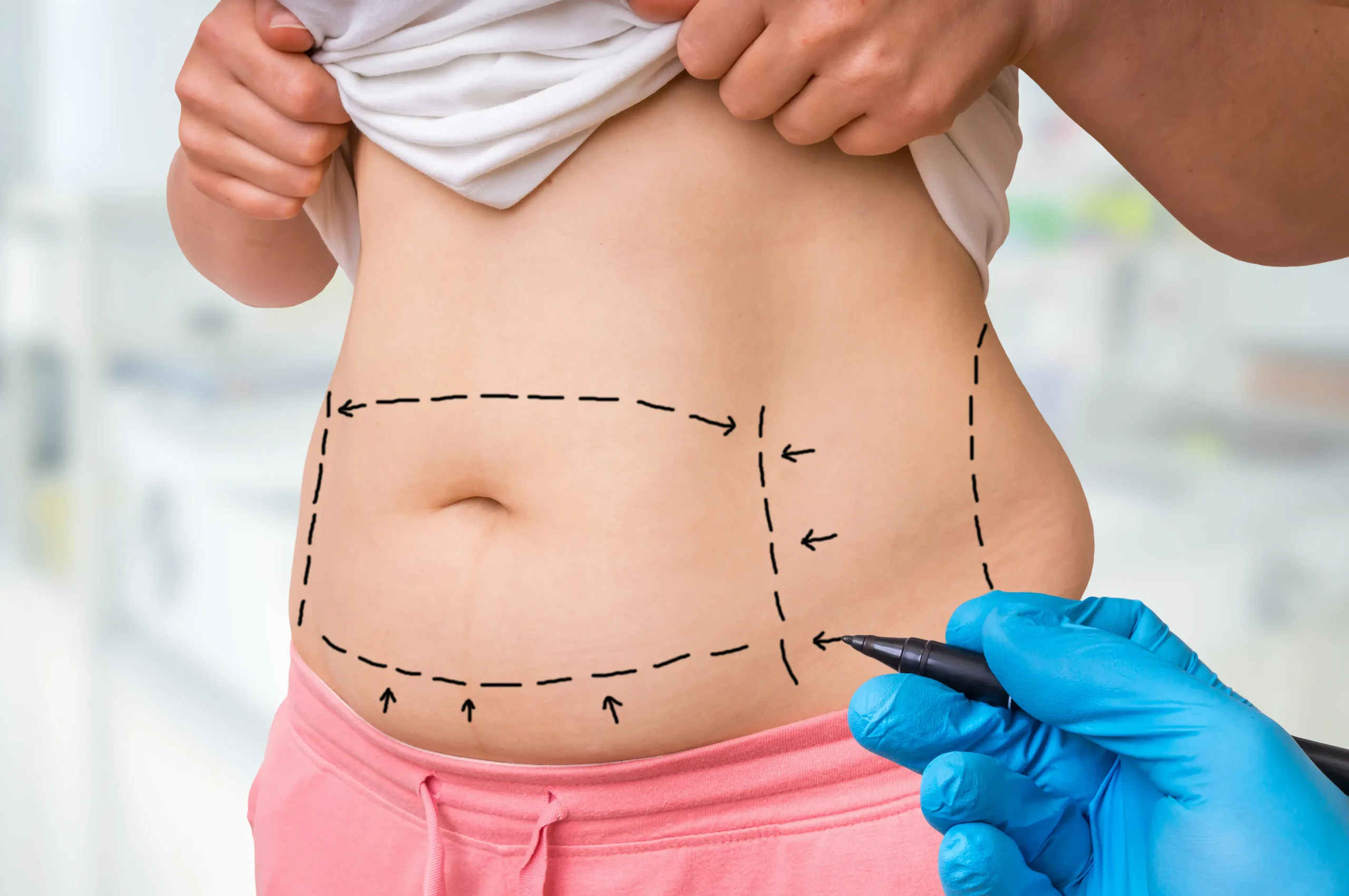 Body contouring procedure with marked areas on abdomen, performed by a healthcare professional wearing blue gloves.