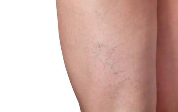 Close-up of a leg showing visible spider veins.