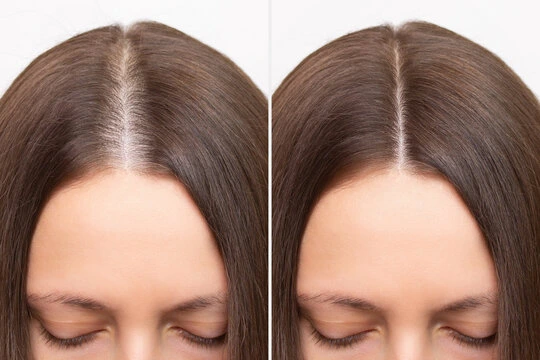 Before and after hair loss treatment showing improved hair density.
