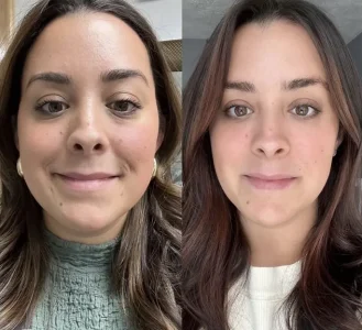 Before-and-after facial enhancement showing skin improvement.