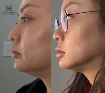 Before-and-after facial transformation with skin treatment.