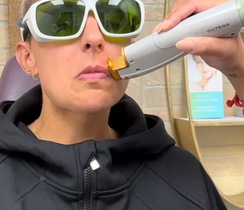 Woman receiving a laser hair removal treatment on her face.