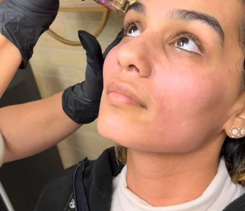 Woman receiving PRP microneedling treatment on her face.