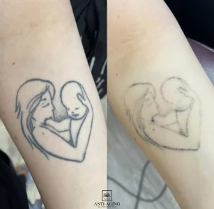 Tattoo removal before and after, showing tattooed heart with two faces inside.