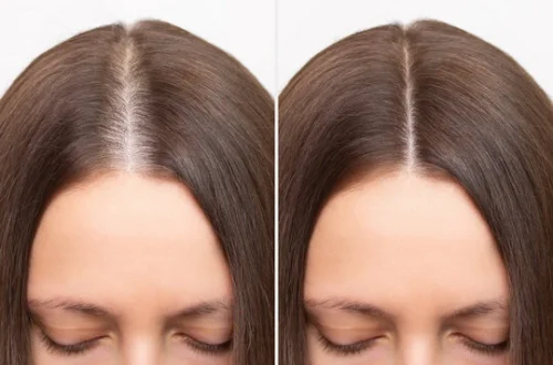 Before and after hair loss treatment showing improved hair density.