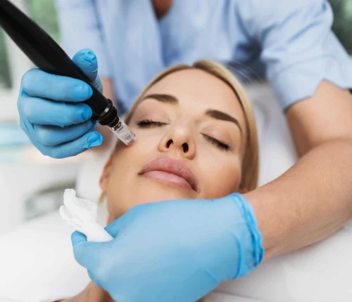 Secret RF microneedling with exosomes