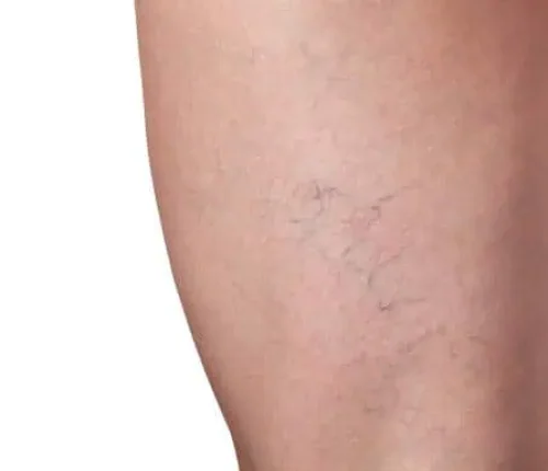 Close-up of a leg showing visible spider veins.