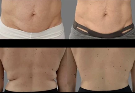 Before and after body contouring showing improved skin tightness and reduction of back fat.