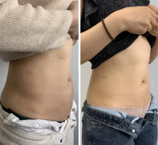 Body transformation showing before and after weight loss or skin tightening.